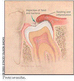 Pericoronitis